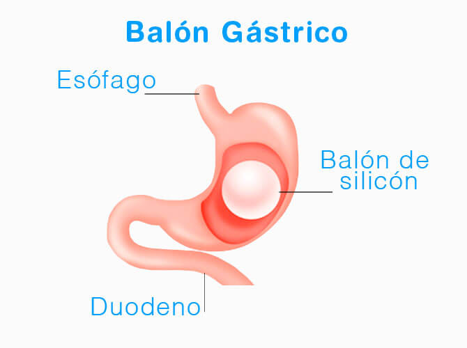 balon gastrico