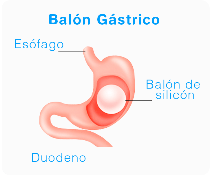 balon gastrico